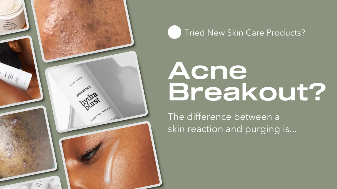 Is Your Skin Purging or Breaking Out?